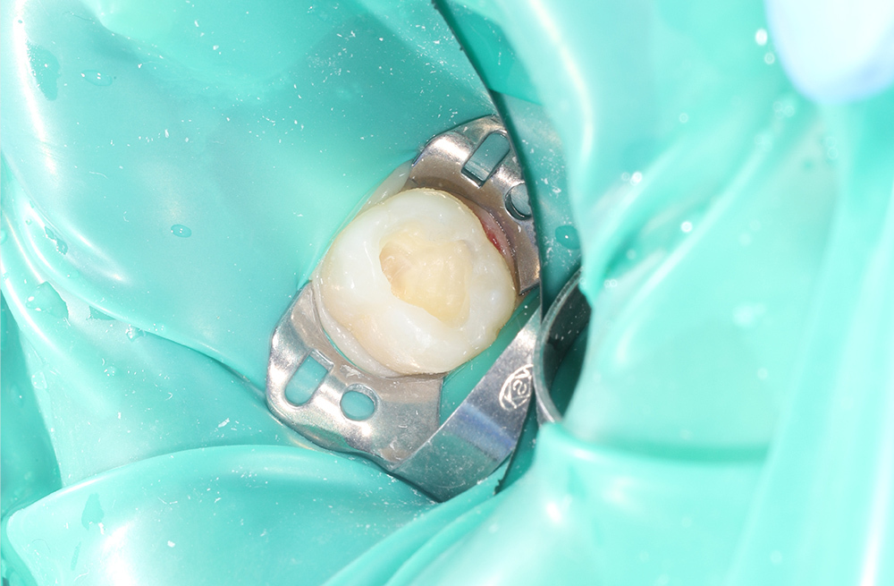 Восстановление зуба композитным материалом ребенку 7 лет