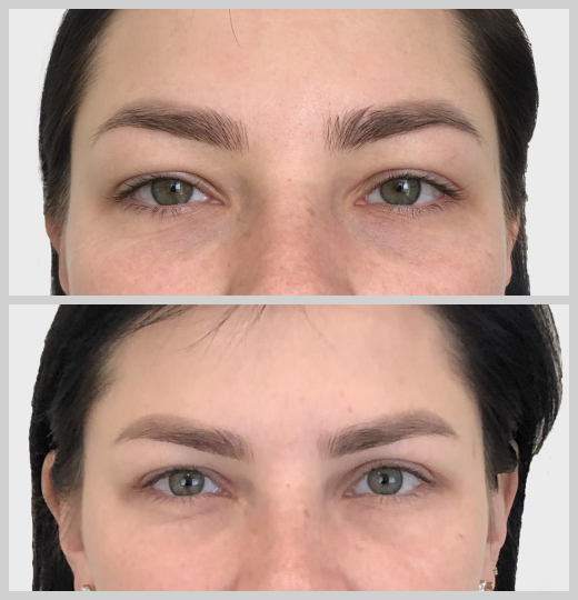 блефаропластика нависшие веки