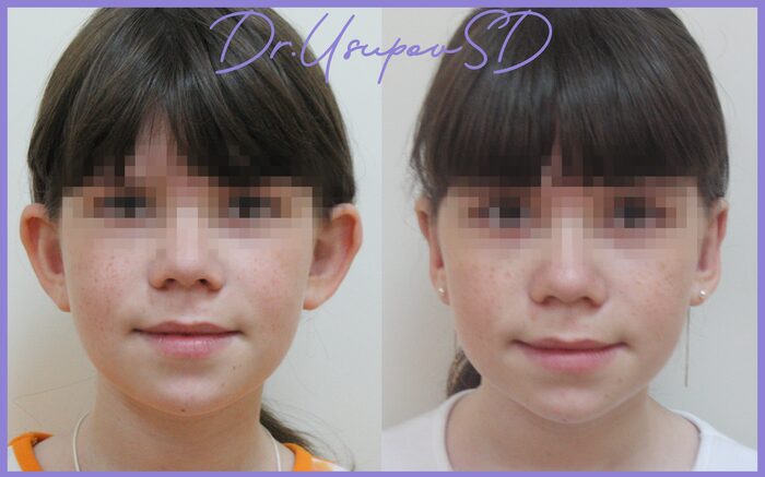 Детская отопластика - фото до/после