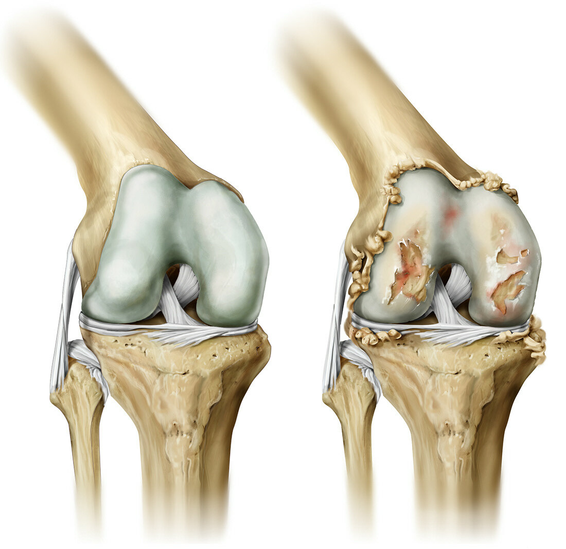 Деформирующий артроз коленного сустава (гонартроз)