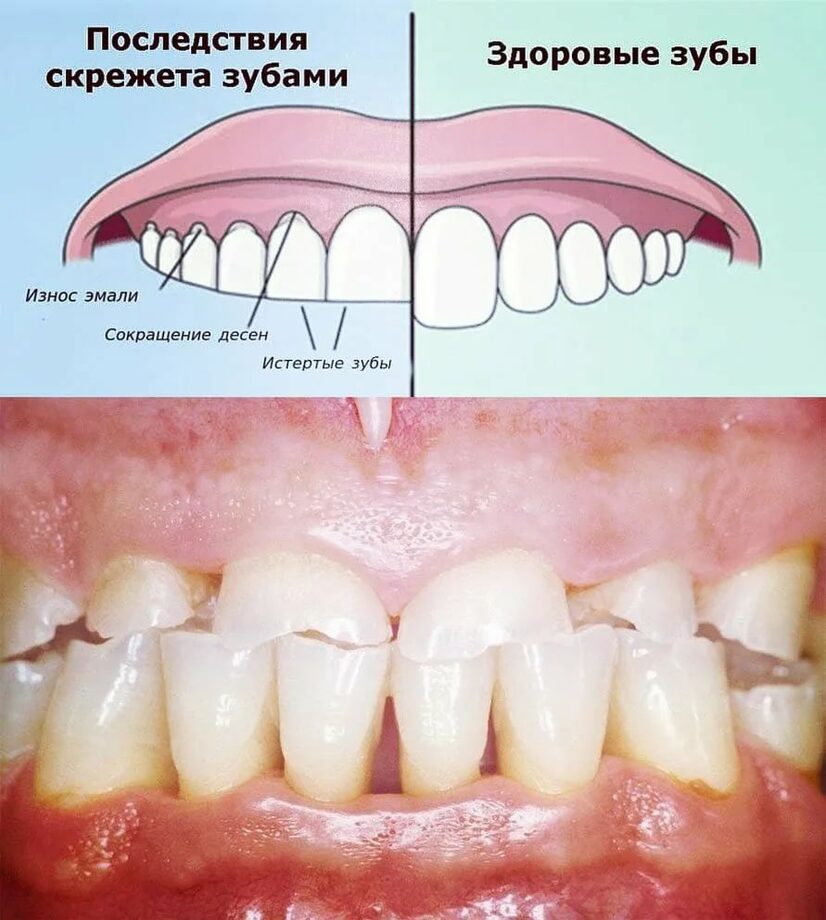 Скрип зубами у детей часть 2 - БЛОГ стоматологии УткинЗуб в Москве