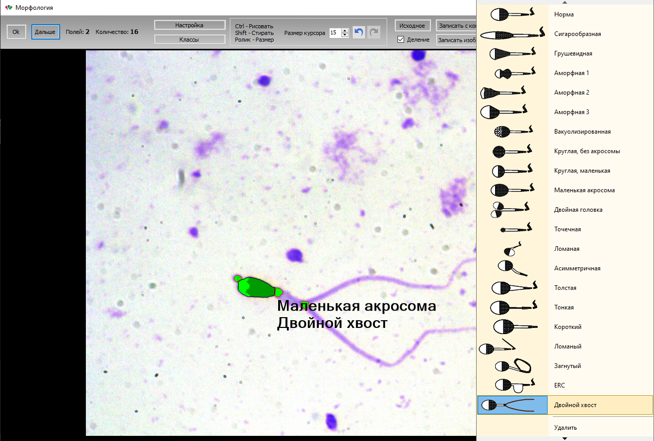 ММС Сперм (MMC Sperm) - автоматизированное программное обеспечение для  анализа качества спермы