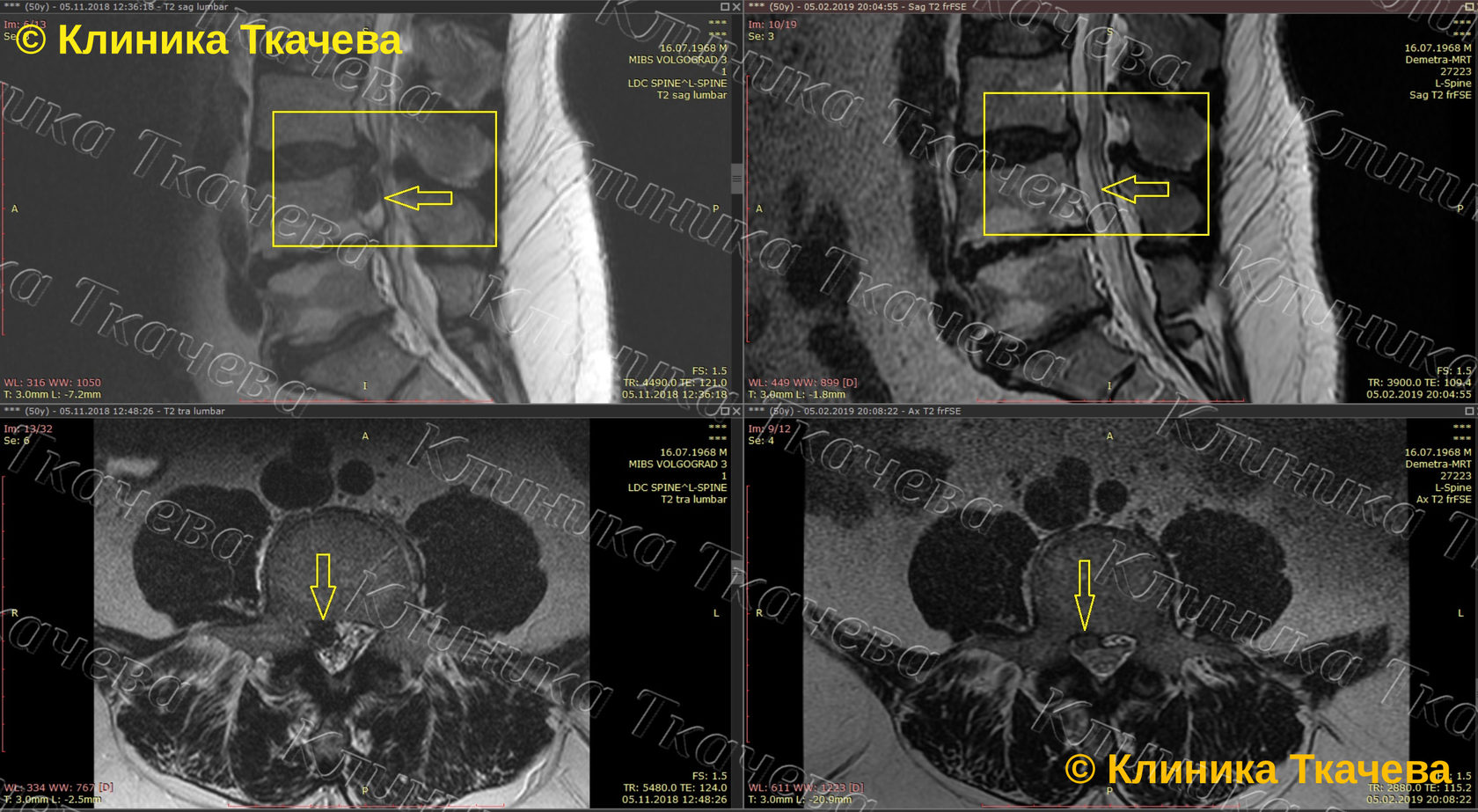 Епифанов грыжа позвоночника. Епифанов клиника позвоночник. Епифанов лфк. Доктор епифанов. Епифанов грыжа.