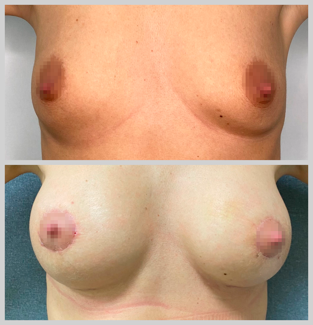 маммопластика увеличение груди импланты