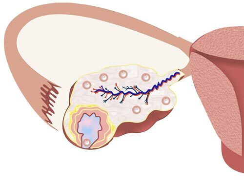 Киста яичника лечение, операция по удалению кисты яичника полостная, лапароскопия кисты цена