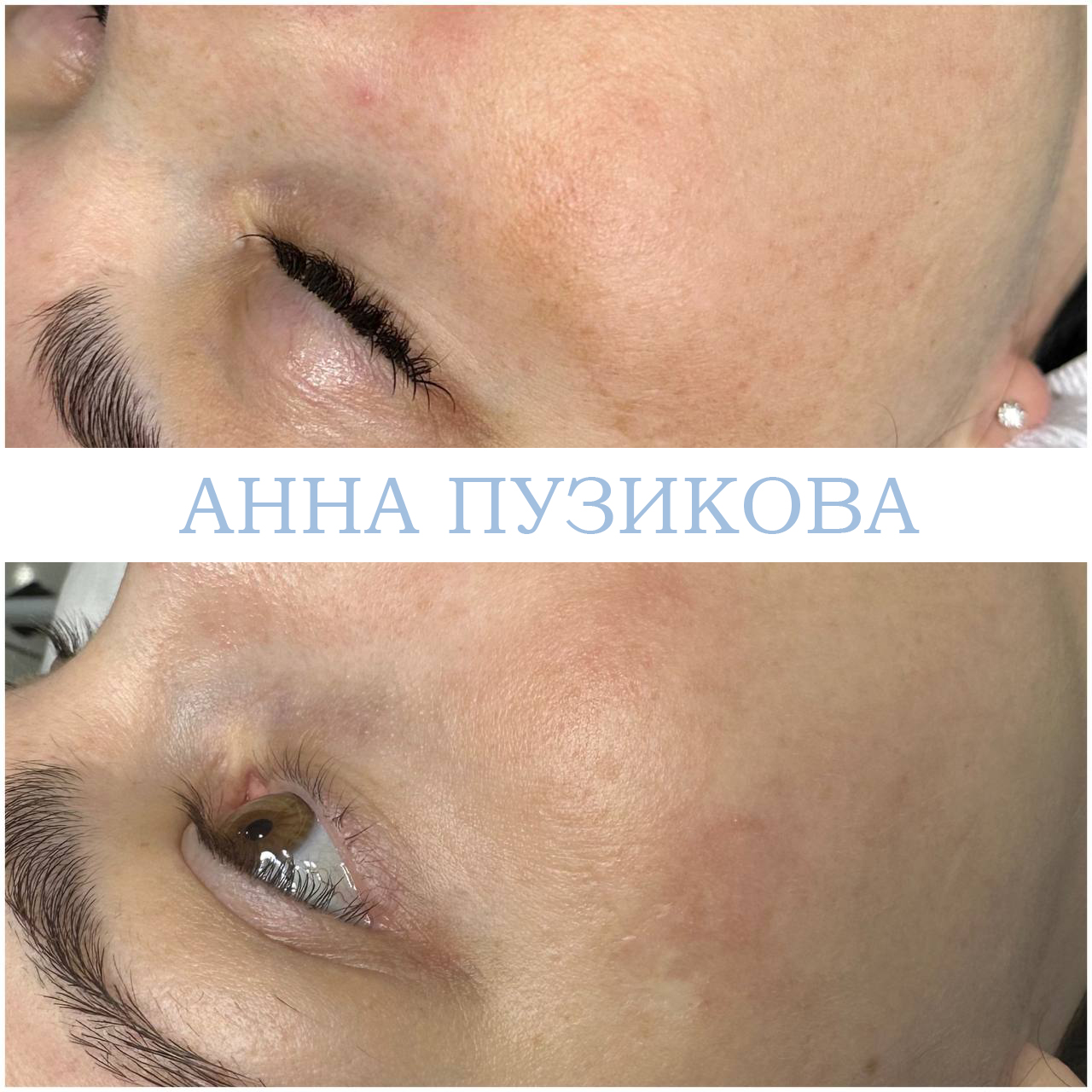 Результат удаления пигментных пятен после курса фототерапии ClearLight IPL — врач-косметолог Пузикова Анна Анатольевна, Санкт-Петербург