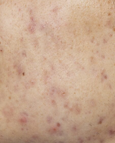 профилактика и коррекция закрытых и открытых комедонов