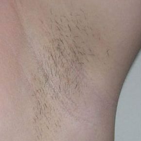 до лазерной эпиляции под мышками