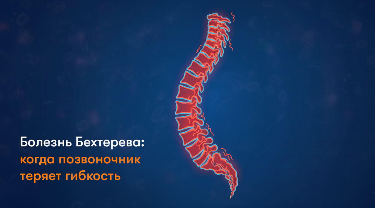 Болезнь Бехтерева