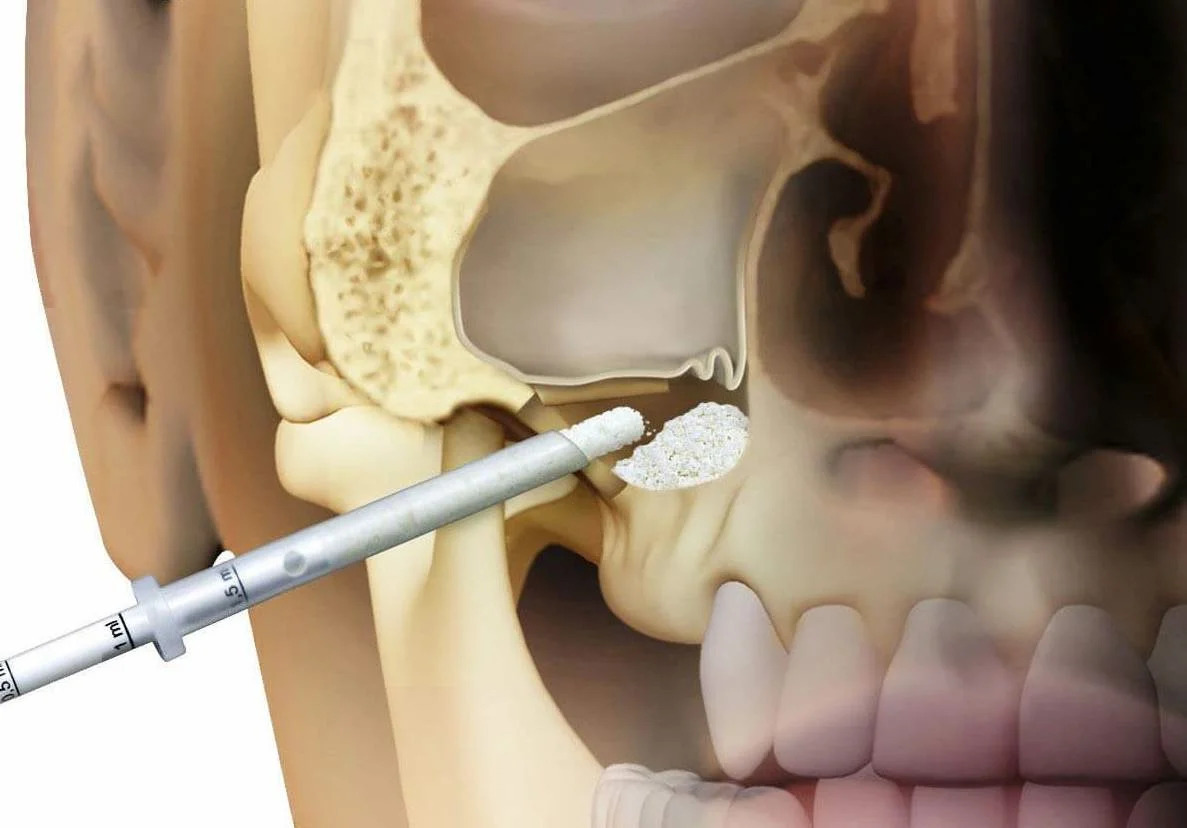 имплантация зубов в Чебоксарах, имплантация чебоксары