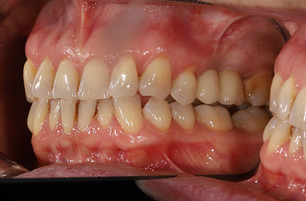 Восстановление зуба с глубоким сколом нёбной стенки через одномоментную имплантацию