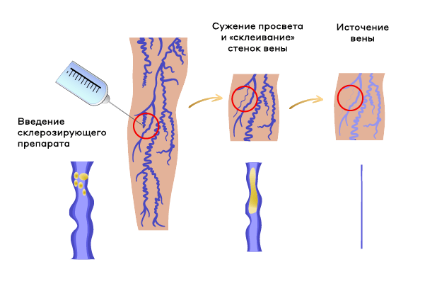 Вены склерозирование