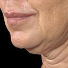 rf-лифтинг пигментация