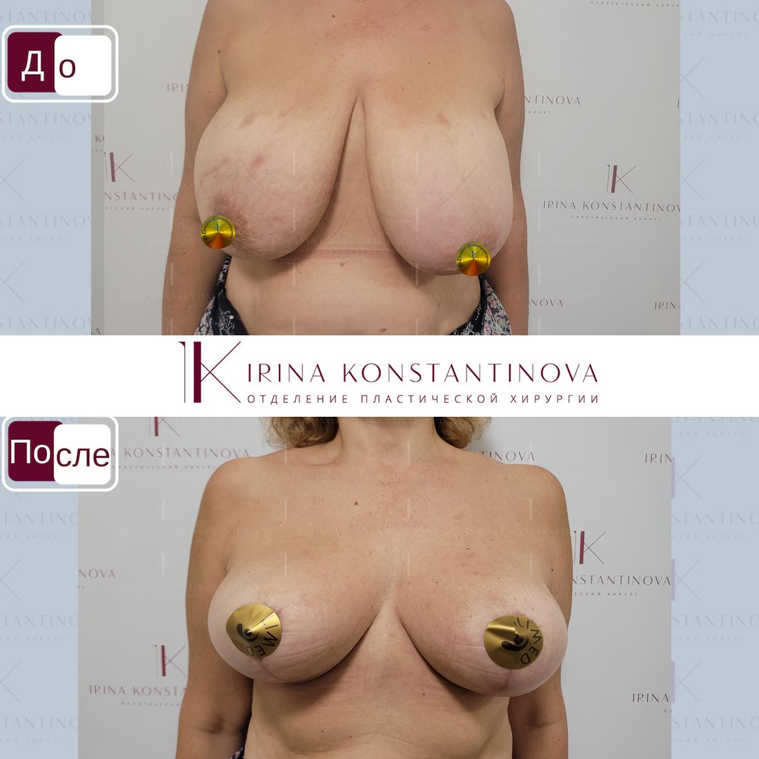 упражнение для уменьшения груди у женщин фото 34