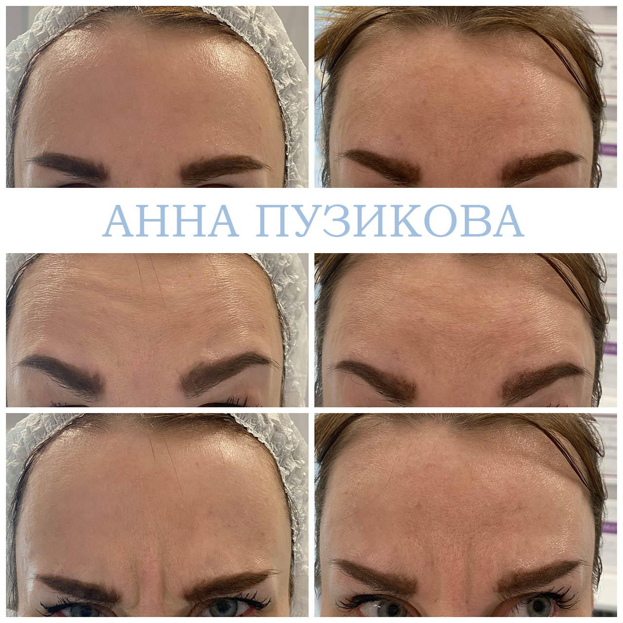 Результат ботулинотерапии — коррекция мимических морщин на лбу и в области глаз. Косметолог Пузикова Анна Анатольевна, Санкт-Петербург