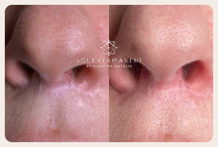 удаление шрама москва до после