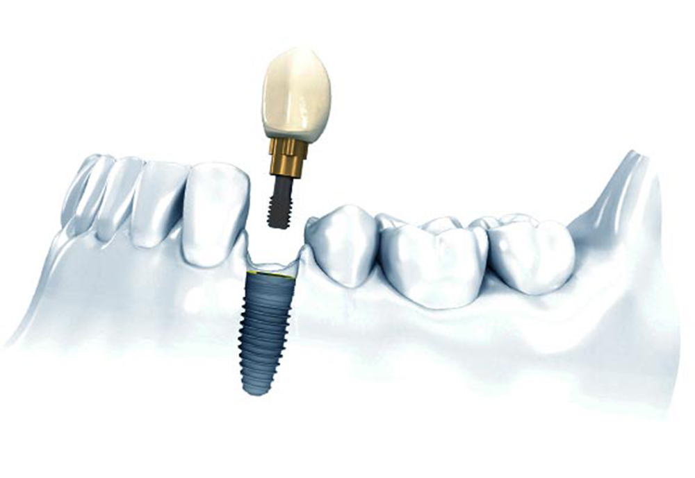 Все об имплантации зубов подробно в деталях с наглядными картинками
