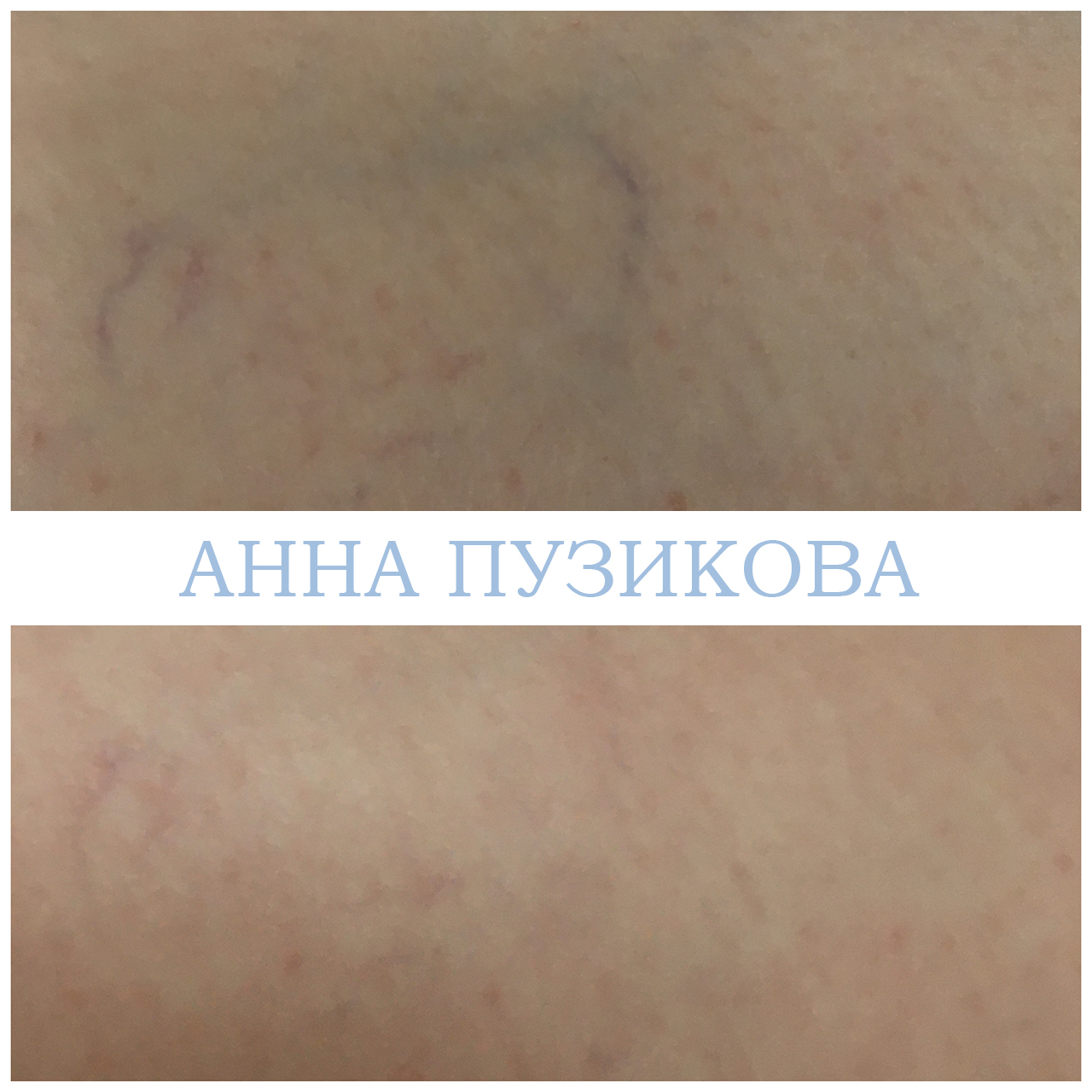 Результат удаления сосудистых звёздочек и купероза на лице с помощью фототерапии ClearLight IPL — врач-косметолог Пузикова Анна Анатольевна, Санкт-Петербург