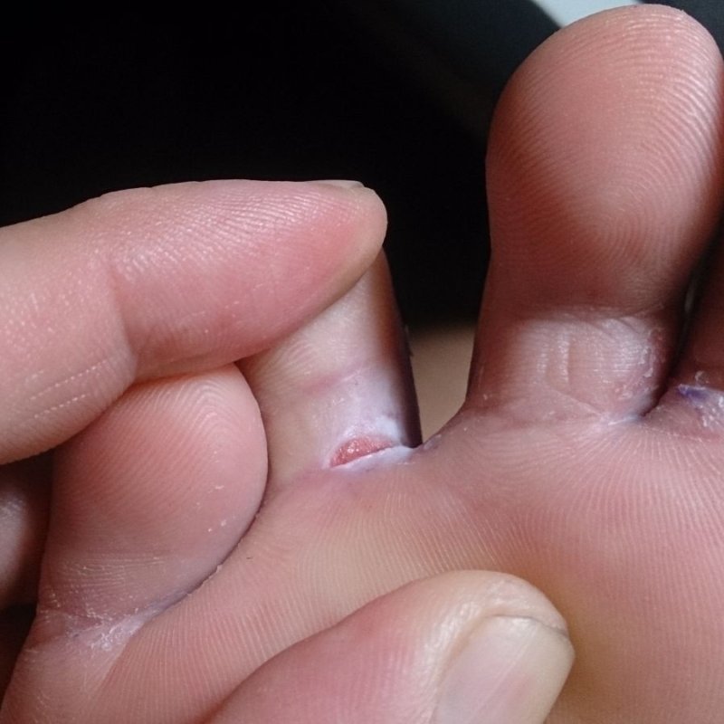 Шишки на пальцах ног - причины и симптомы