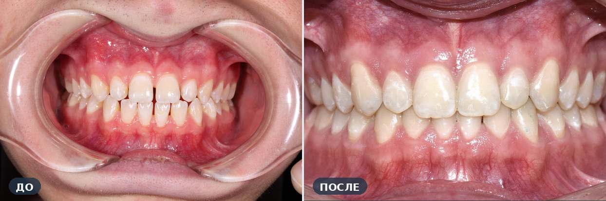 Ортодонтическое лечение: Узкий зубной ряд — до и после