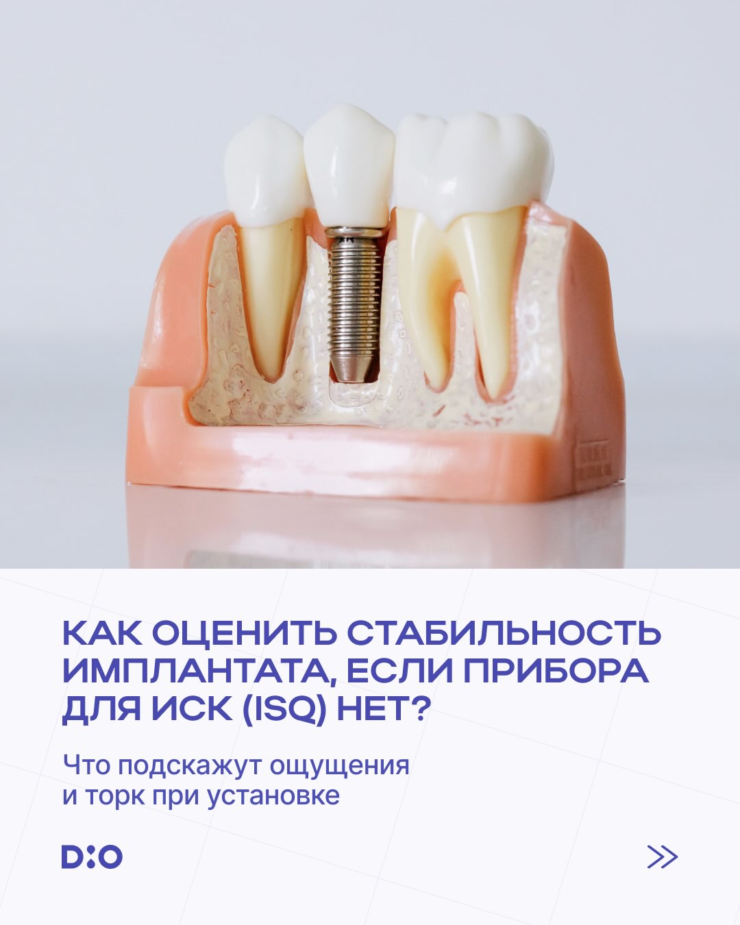 DIO Implant