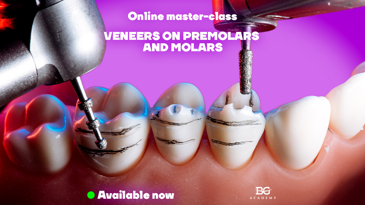 Veneers on premolars and molars. Clinical aspects of tooth preparations.