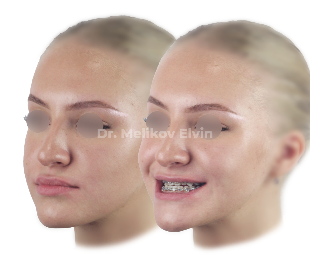 Мезиальный прикус