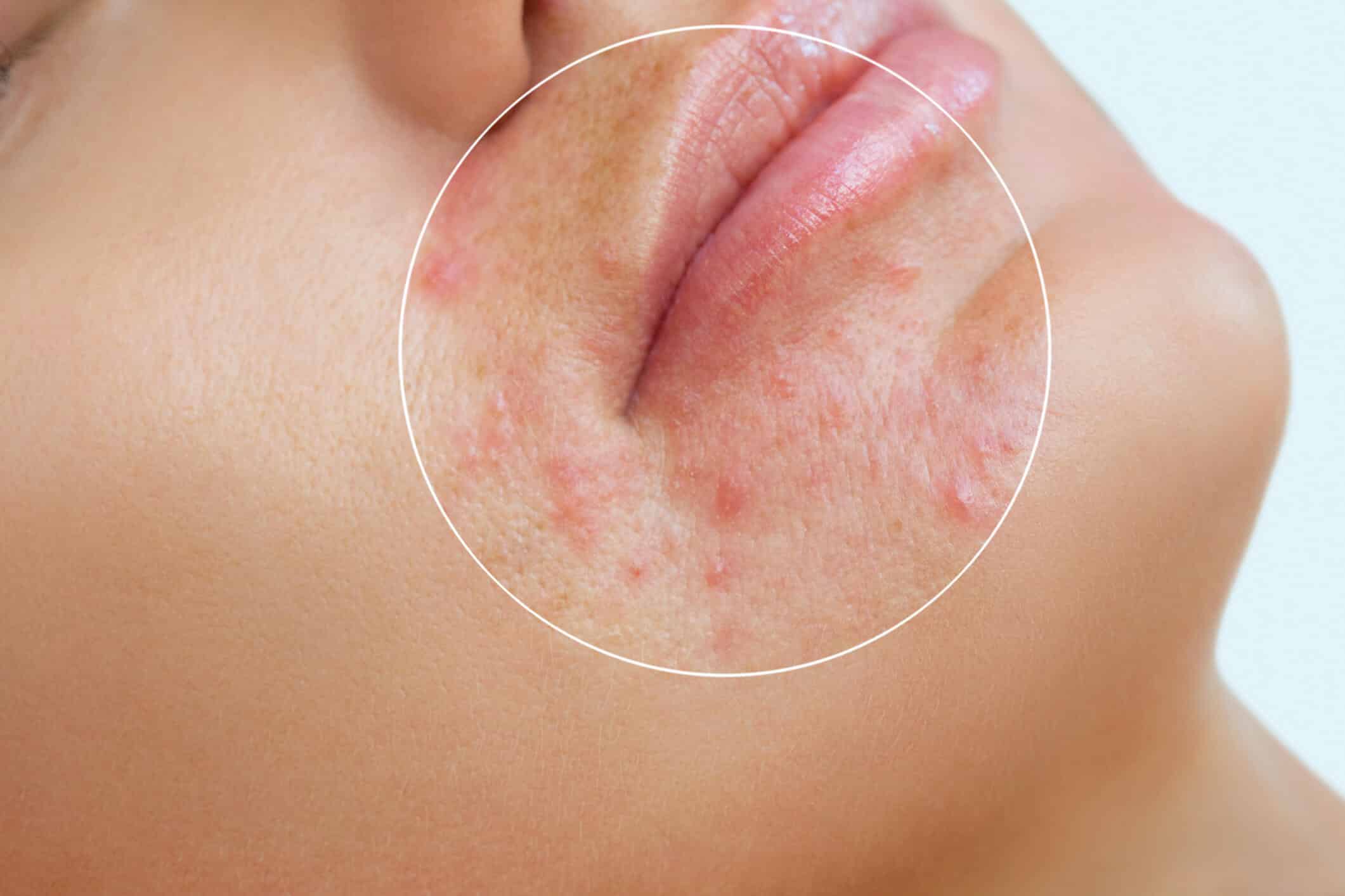 First acne consultation and facial treatment at Beauty Studio by Hanna in Mount Pleasant, SC
