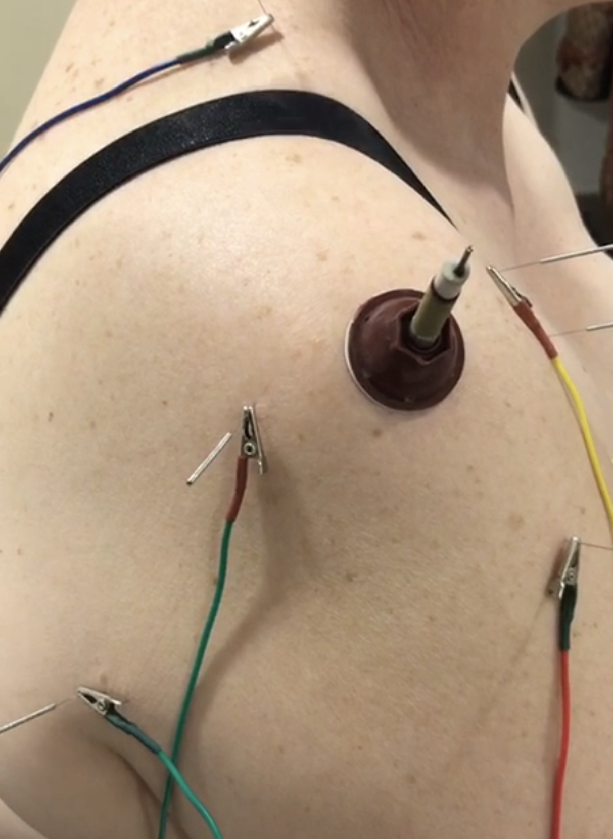 электроакупунктура, моксотерапия, лечение боли в плече