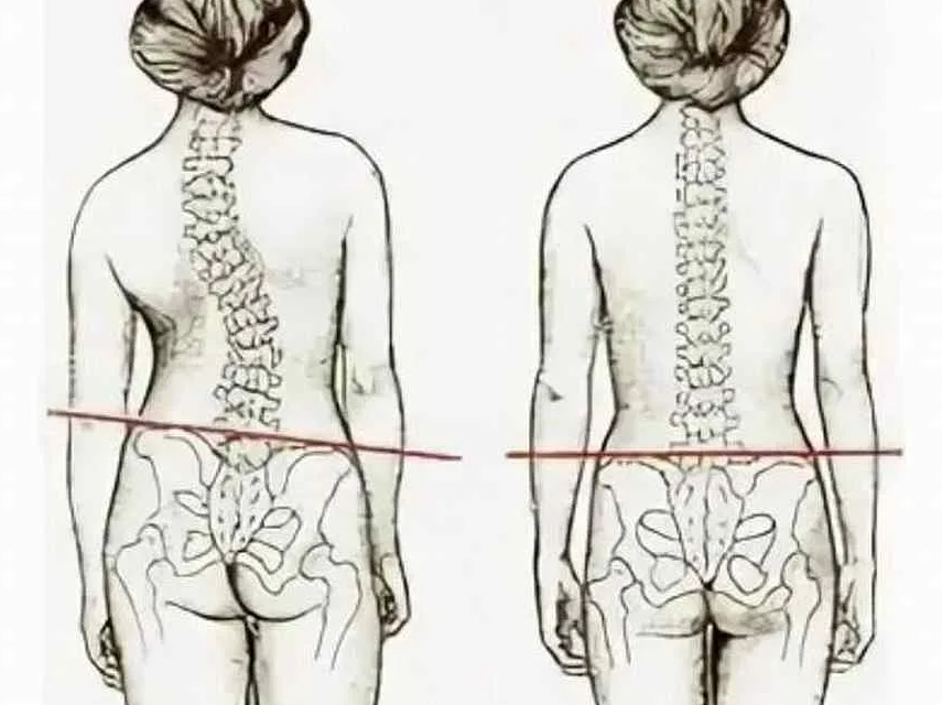 Выравнивание таза. Искривление позвоночника смещение таза. Кости таза при сколиозе. Сколиоз со смещением таза.