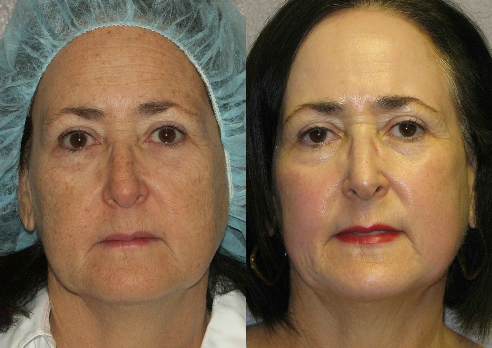 Плазменная подтяжка. Плазмотерапия лица. Лазерная шлифовка кожи до и после. Дермабразия лица.