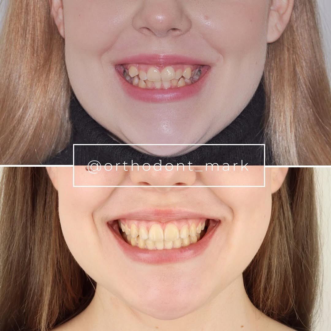 Before and after photos showing corrected arch width, alignment, and symmetrical smile — photo 1 of 1
