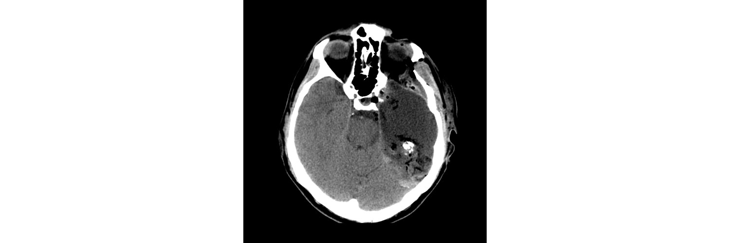 Тератома - Диагностика и лечение