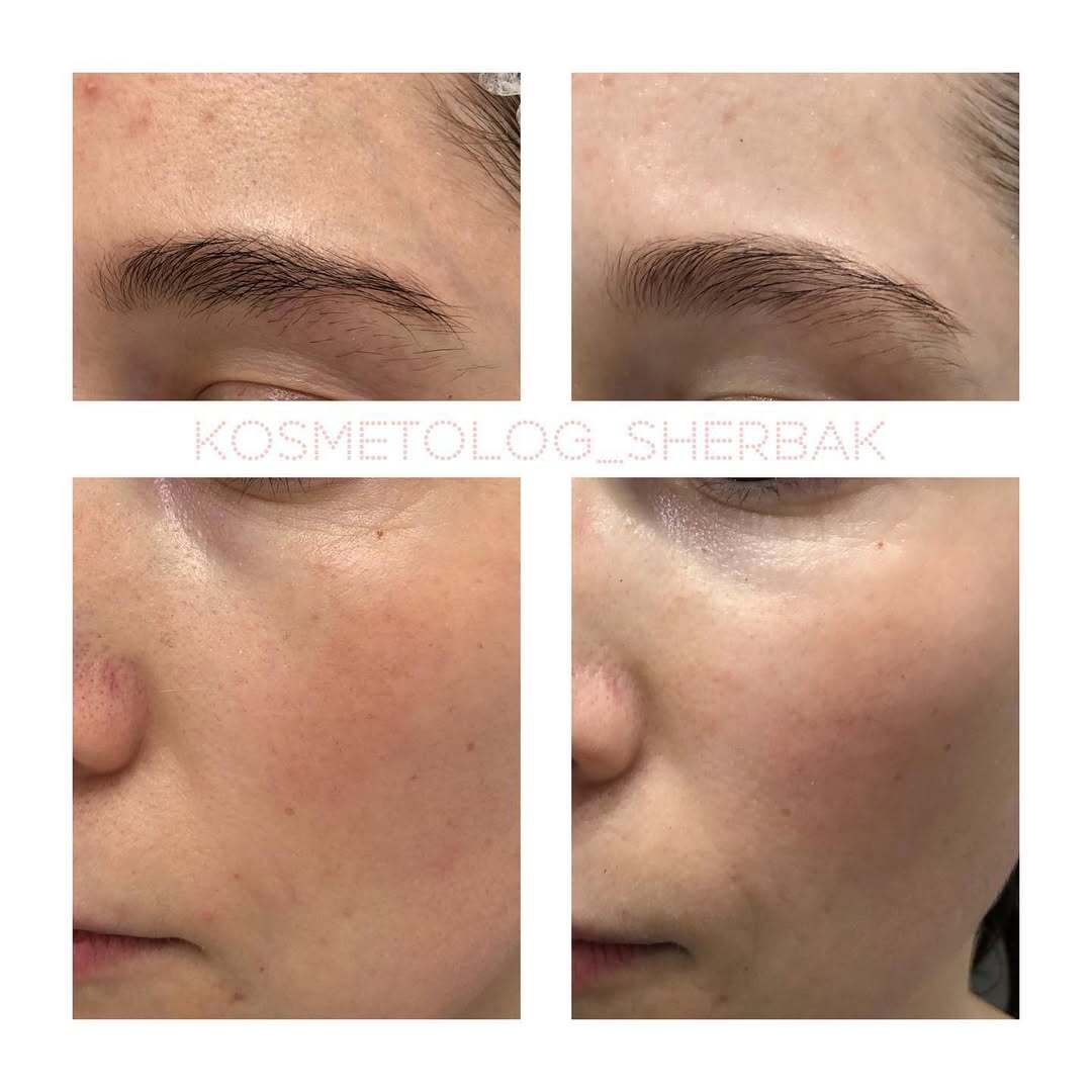 Контурная пластика лица в клинике PradusCOSMO, Санкт-Петербург. Естественный результат без эффекта переделанного лица