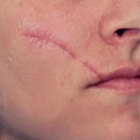 rf-лифтинг лица