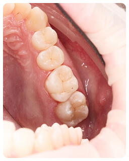 Лечение корневых каналов в стоматологии Дент-Арт