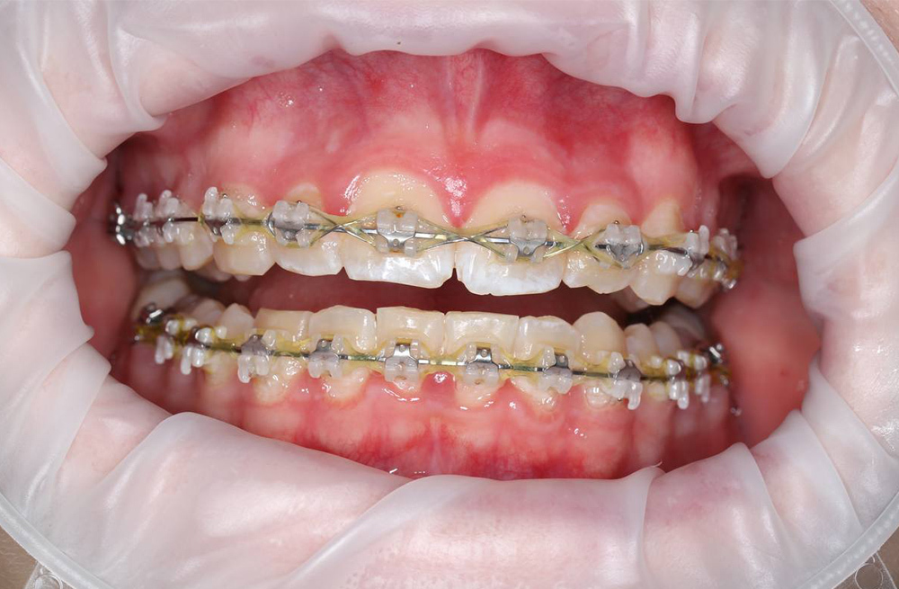 Профессиональная чистка зубов подростку с брекетами