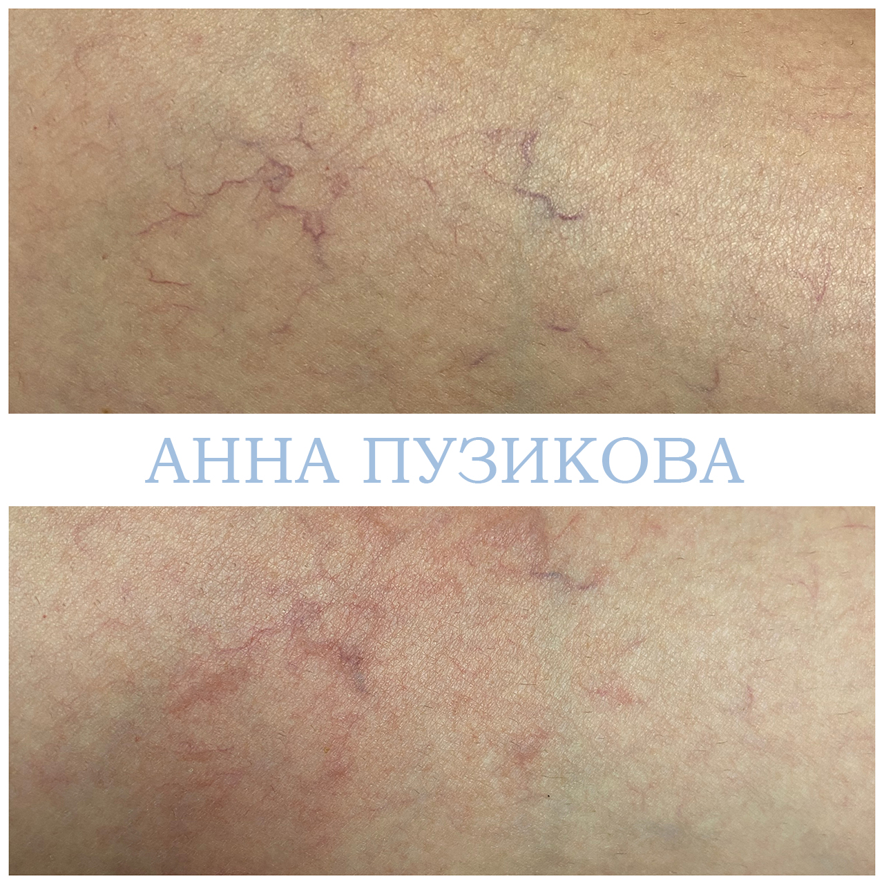 Результат удаления сосудистых звёздочек и купероза на лице с помощью фототерапии ClearLight IPL — врач-косметолог Пузикова Анна Анатольевна, Санкт-Петербург
