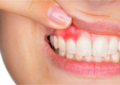 Лечение зубов при месячных