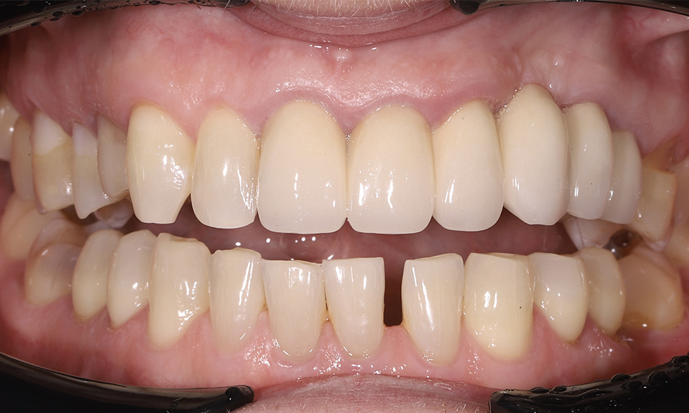 Ортодонтическая подготовка к имплантации при недостатке места на нижней челюсти