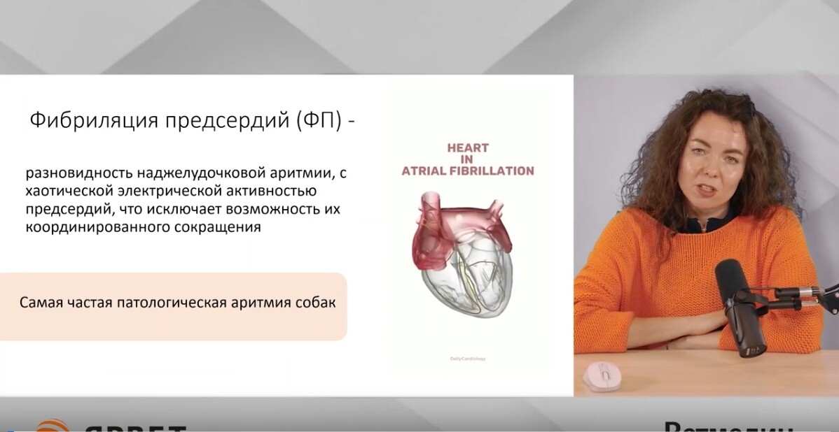Фибрилляция предсердий
