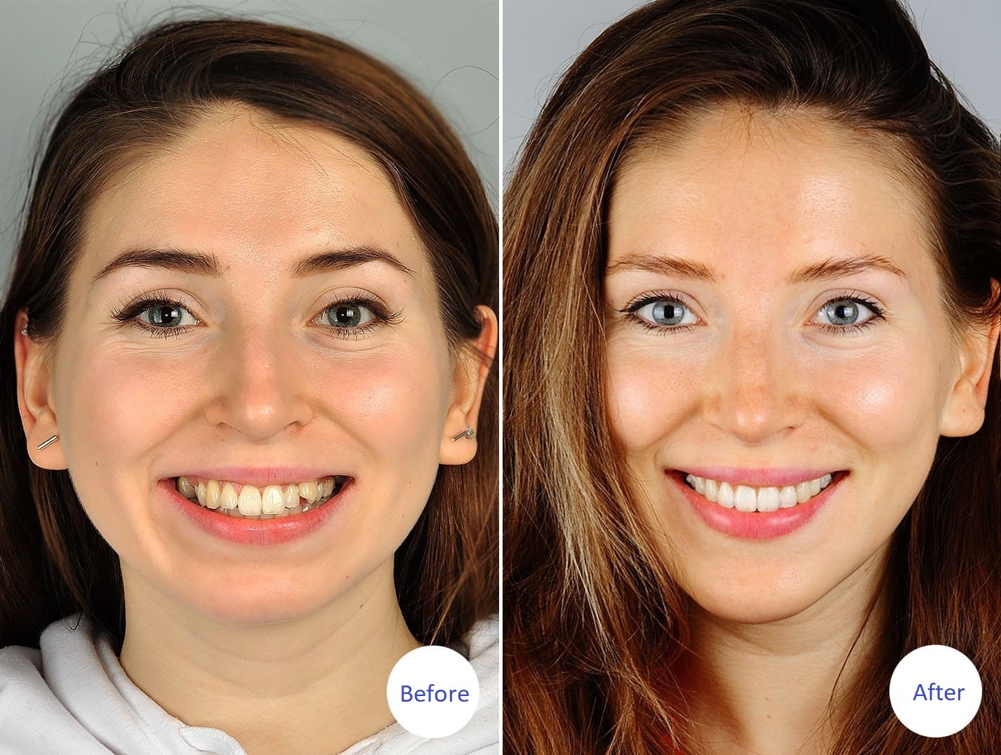 How Braces Change Your Face Shape?