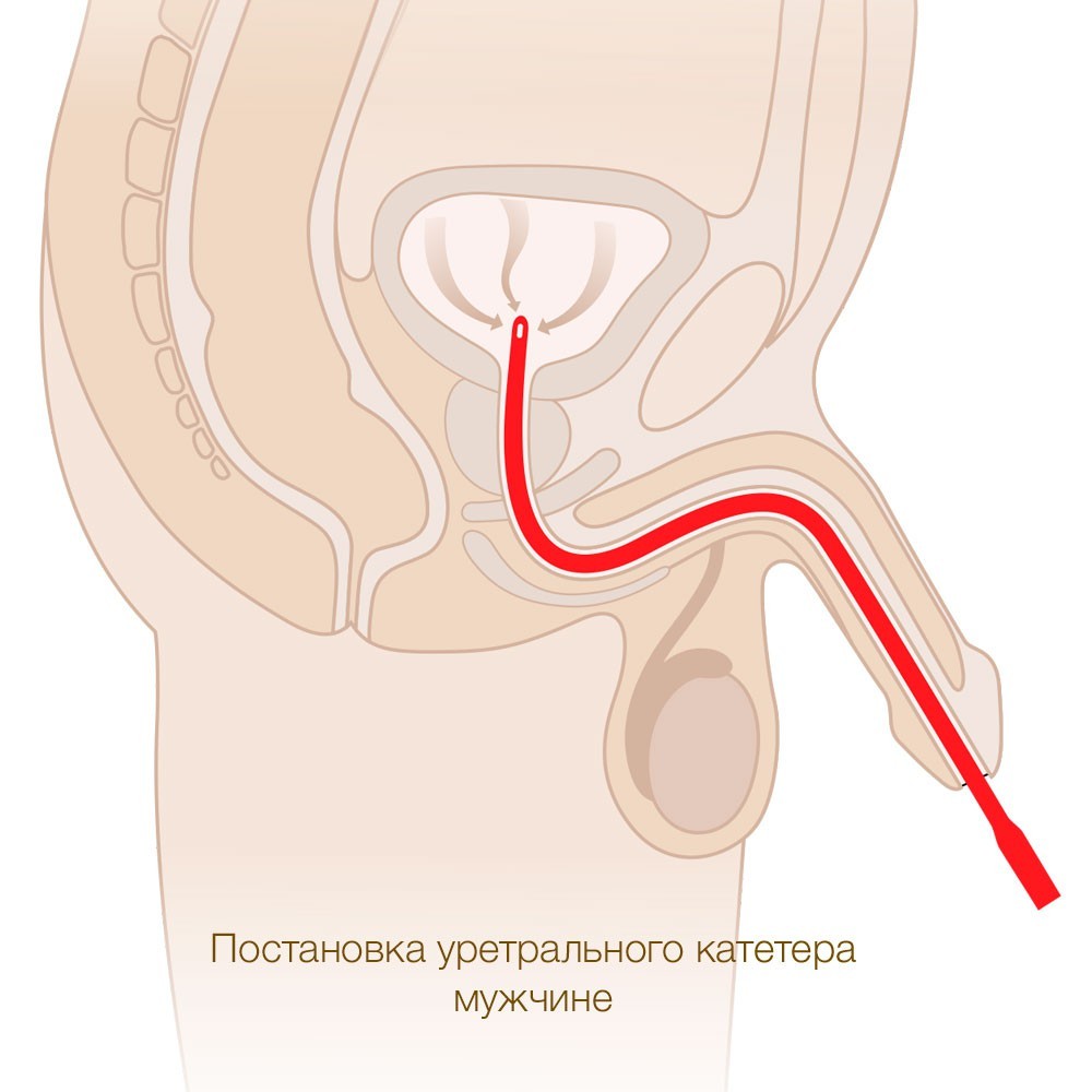 уропрезервативы