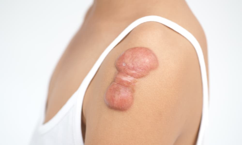 Keloid Scars