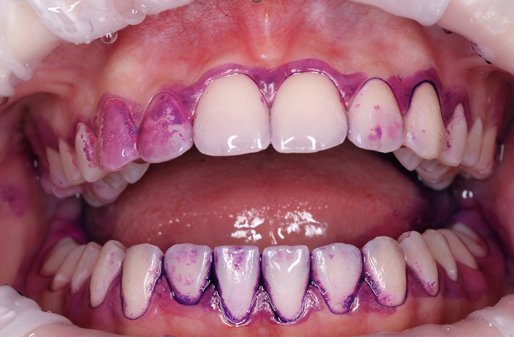 Профессиональная чистка зубов с ретейнерами подростку 14 лет