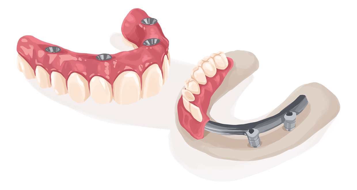 Несъемный зубной протез на 4 имплантах. Покрывной протез на имплантах.