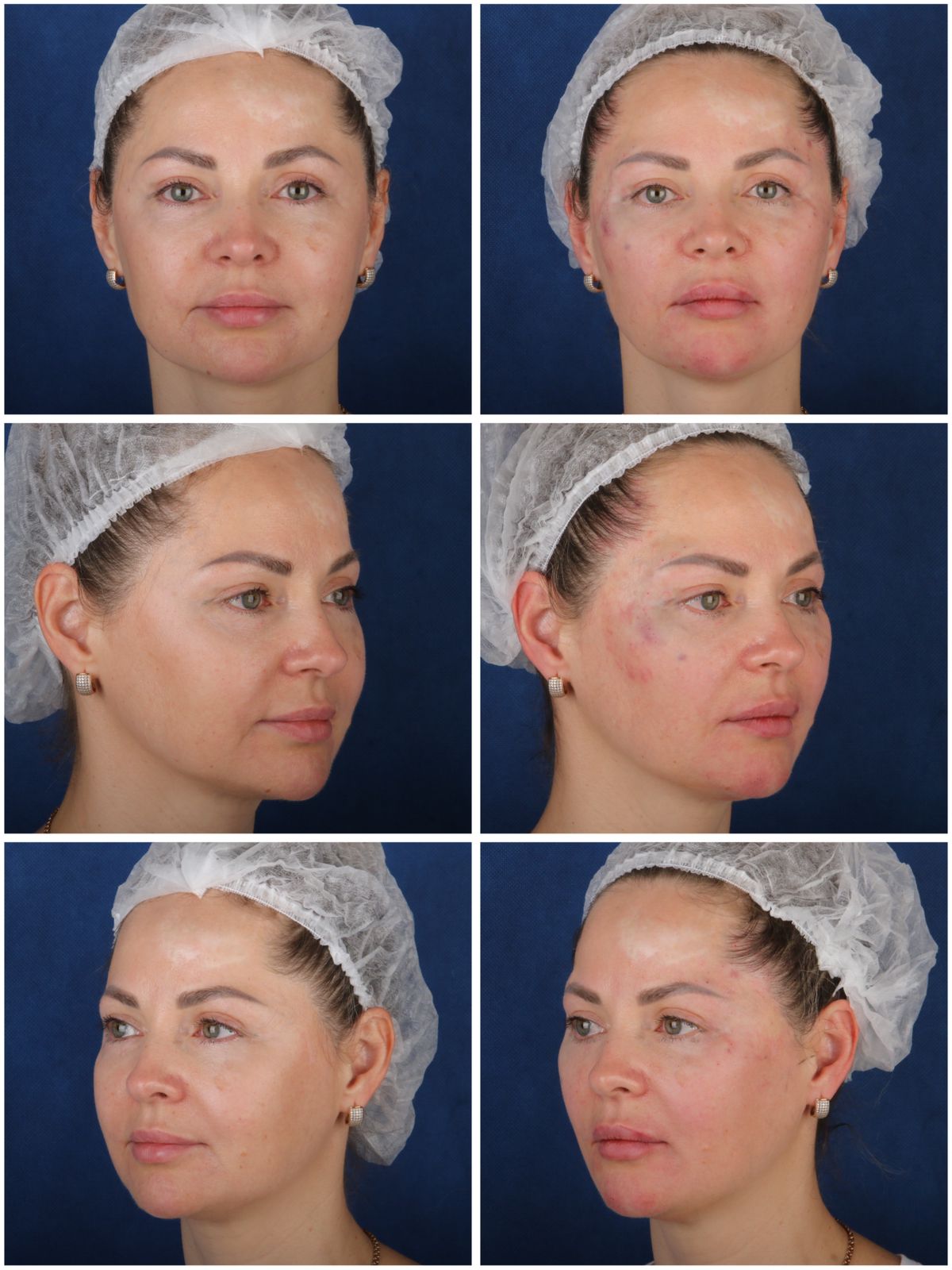 Фото до и после: V-lifting в клинике PradusCOSMO, Санкт-Петербург. Безоперационное омоложение и восстановление овала лица