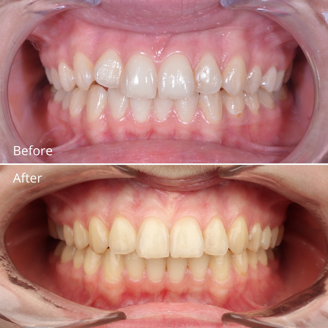 Stage photo showing alignment progress with the Damon braces system — photo 2 of 5