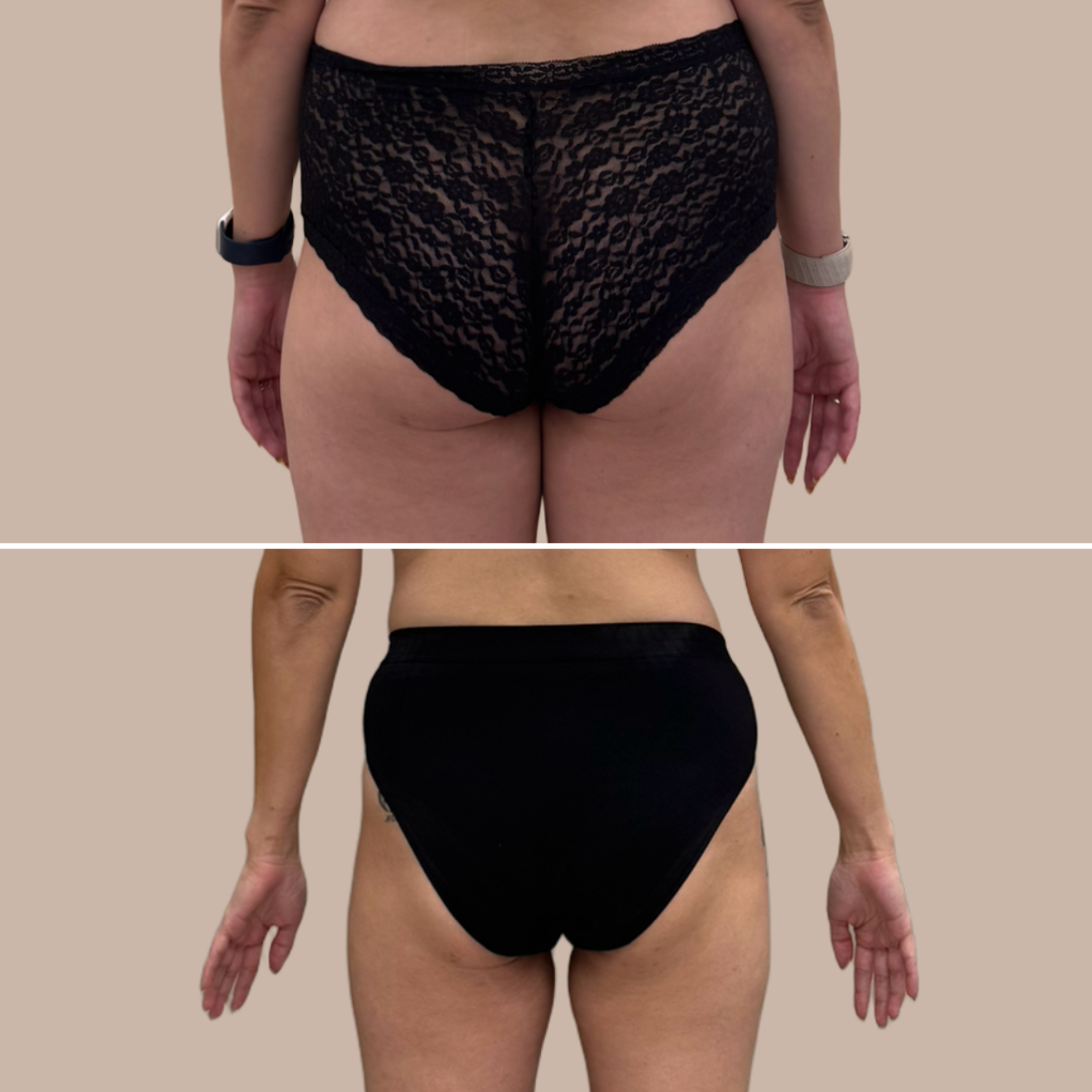 Мезотерапия тела + Циклосфера 