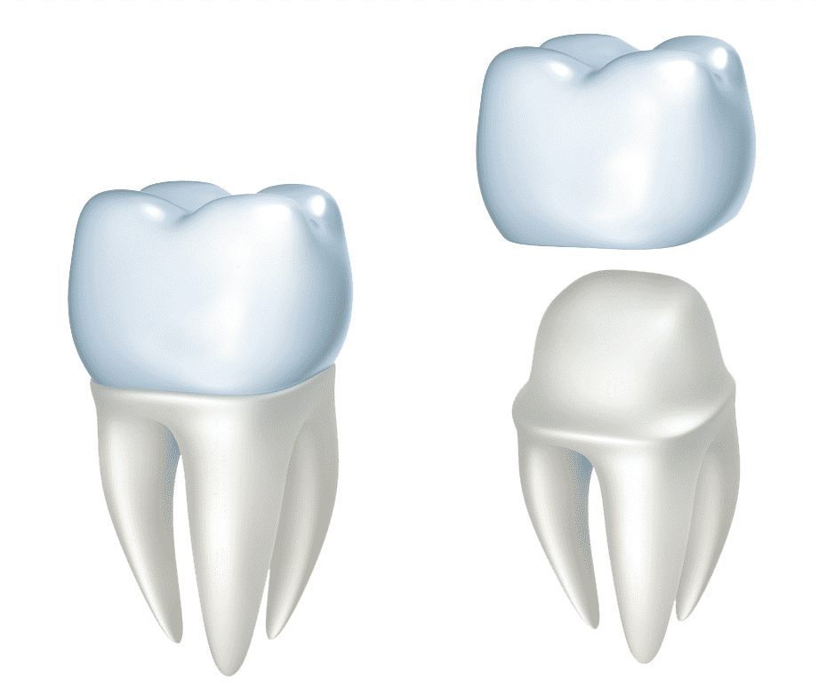 Металлокерамическая коронка CAD/cam. Dental Zircon Crown.